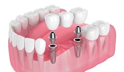 Illustration of an implant bridge