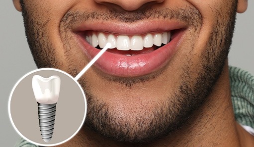 Dental implant before receiving restoration