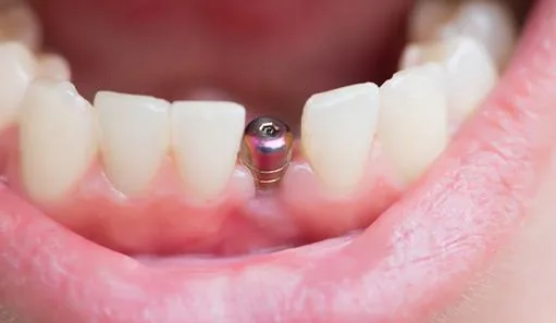 Dental implant before receiving restoration