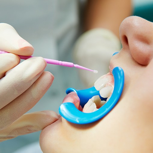 Young patient receiving fluoride treatment