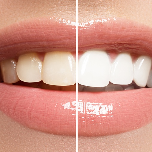 Smile before and after teeth whitening