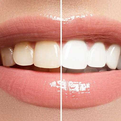 Smile before and after teeth whitening