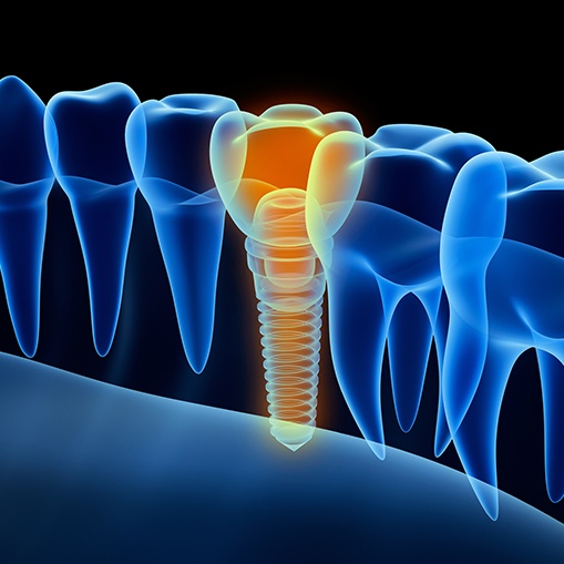 3 D animated dental implant supported replacement tooth