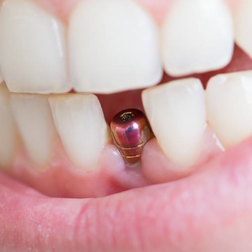 Smile with dental implant post visible