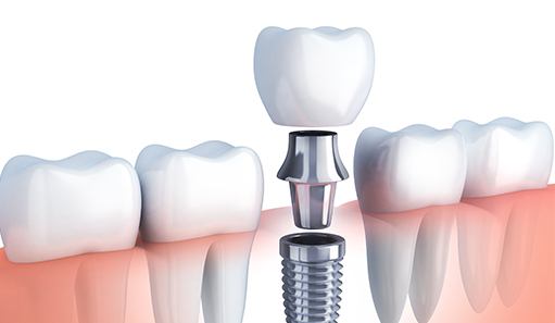 Animated dental implant supported dental crown placement