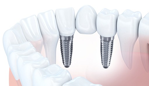 Animated dental implant supported fixed bridge placement