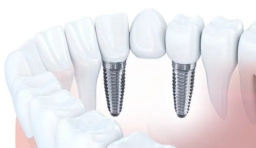 Animated dental implant supported fixed bridge placement