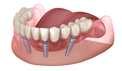 Animated dental implant supported denture placement