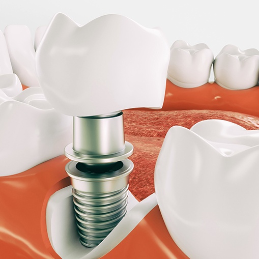 Animated parts of a dental implant supported replacement tooth