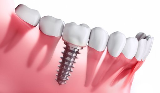 diagram of a single dental implant in Oshkosh