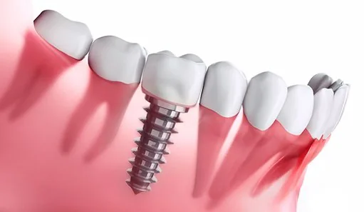 diagram of a single dental implant in Oshkosh