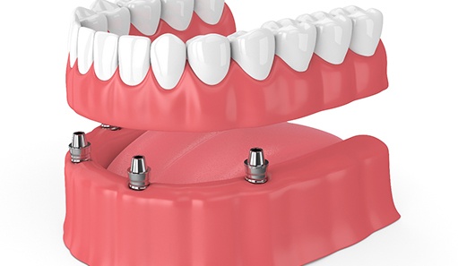 diagram of implant dentures in Oshkosh