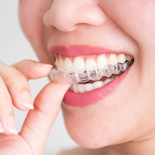 An up-close view of a person inserting an Invisalign aligner into their upper arch