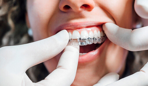 dentist placing clear aligners on patients teeth
