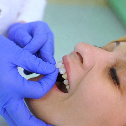 A dentist placing veneers on a female patient’s upper front teeth