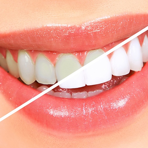 Teeth whitening treatment before and after