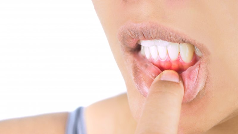 a view of a person pulling down their lower lip to expose their red and swollen gums 