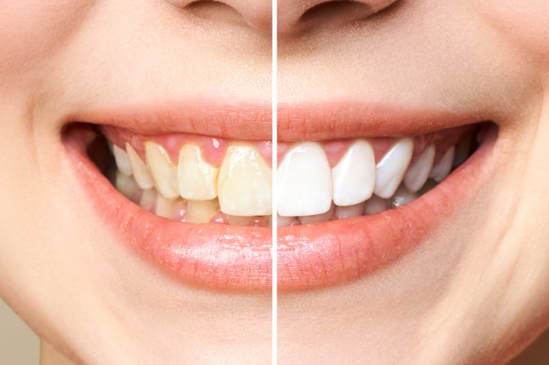 a before and after of teeth whitening in Oshkosh